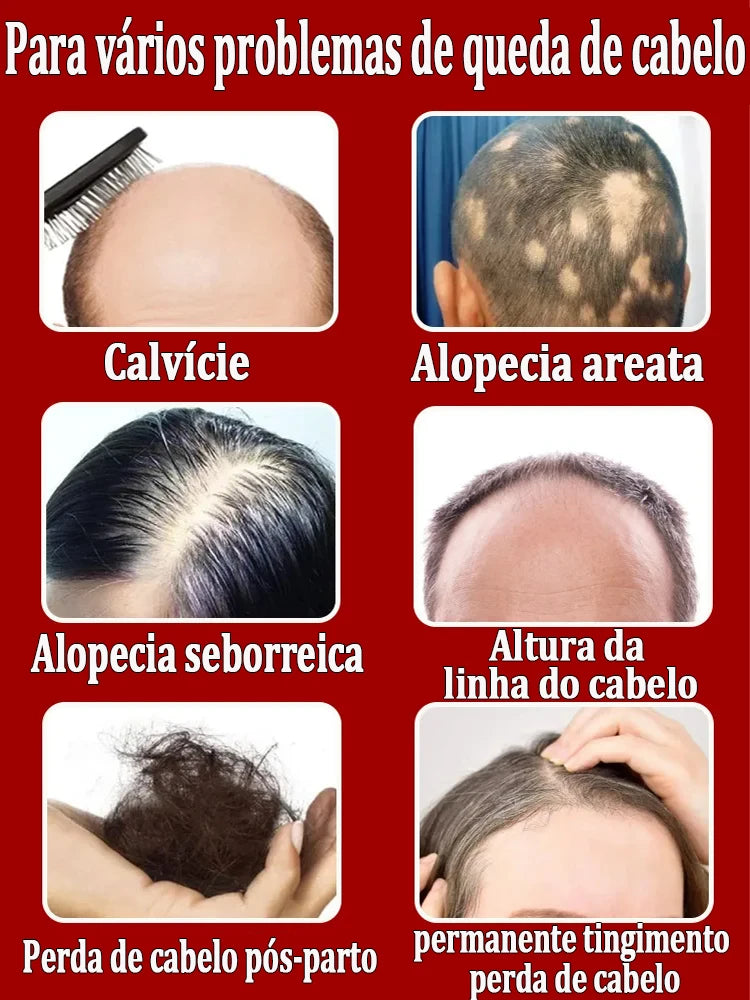 El salvador de la caída del cabello. Repara la línea capilar. Dile adiós a la calvicie y la caída del cabello.