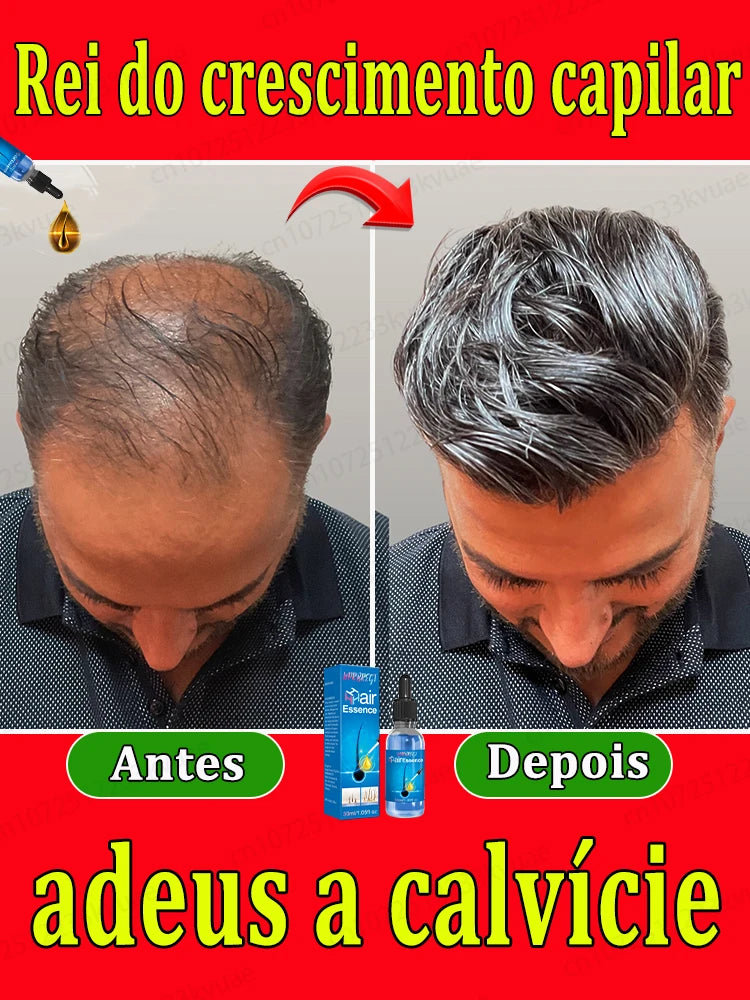 El salvador de la caída del cabello. Repara la línea capilar. Dile adiós a la calvicie y la caída del cabello.